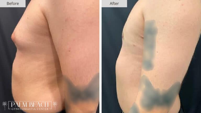Palm Beach Gynecomastia Before and After 1