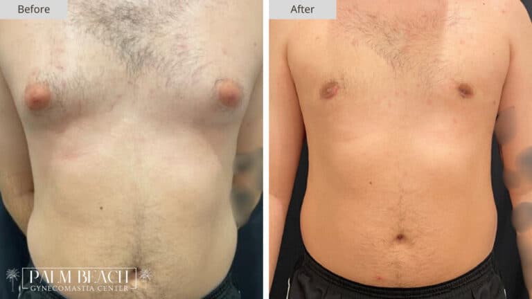 Palm Beach Gynecomastia Before and After 2
