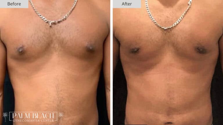 Palm Beach Gynecomastia Before and After 3