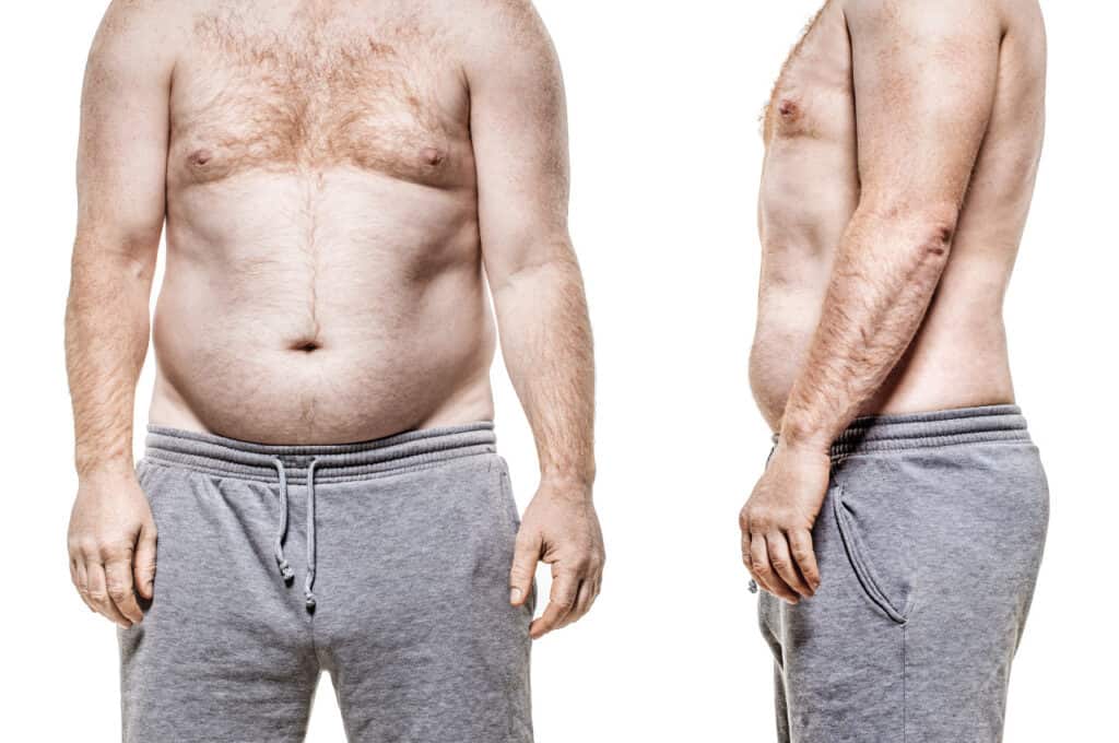 can weight loss make gynecomastia go away