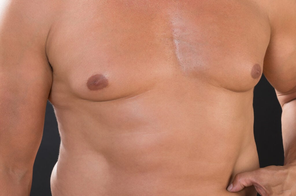 understanding gynecomastia