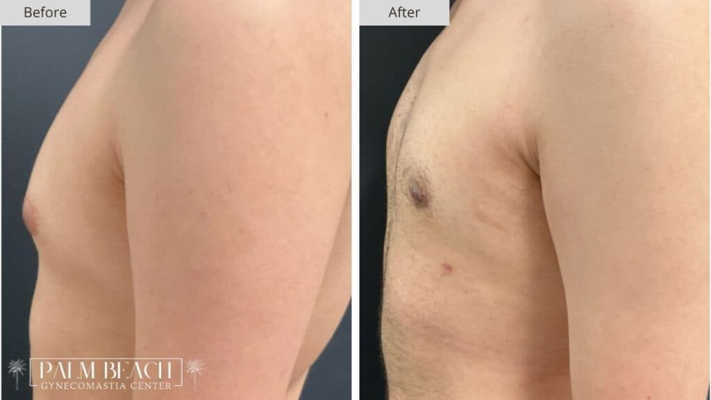 Palm Beach Gynecomastia Before and After 4a