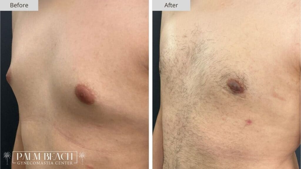 Palm Beach Gynecomastia Before and After 4b