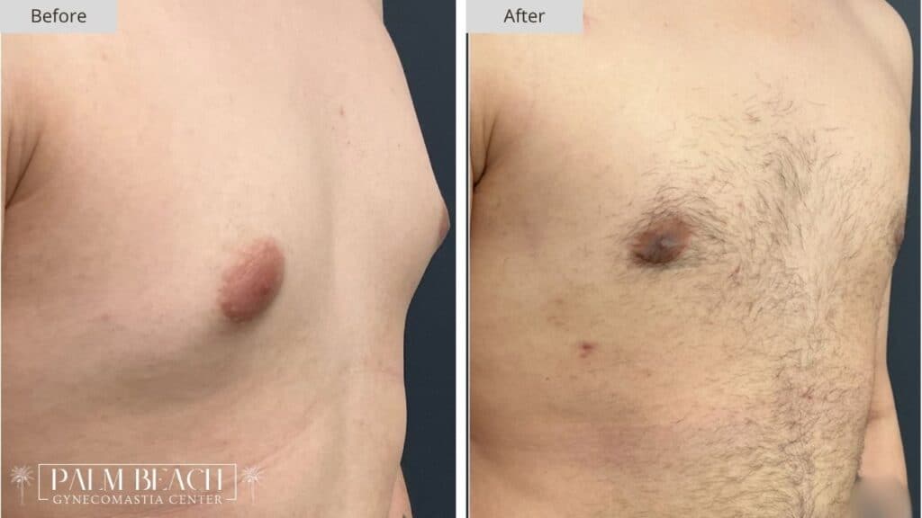 Palm Beach Gynecomastia Before and After 4c
