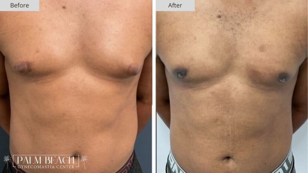 Palm Beach Gynecomastia Before and After 5a