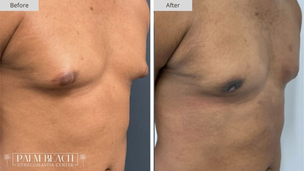 Palm Beach Gynecomastia Before and After 5b