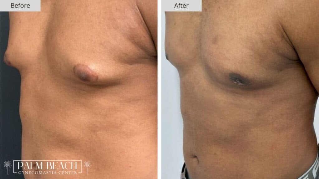 Palm Beach Gynecomastia Before and After 5c