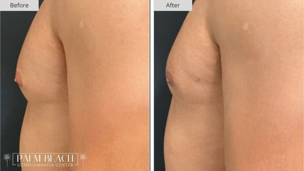 Palm Beach Gynecomastia Before and After 6a