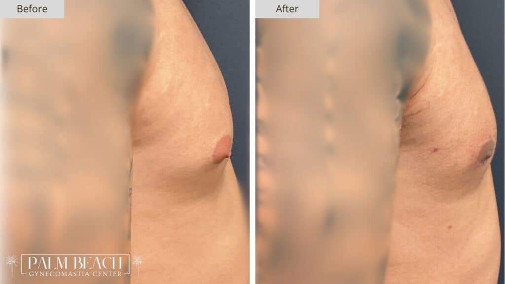 Palm Beach Gynecomastia Before and After 6b