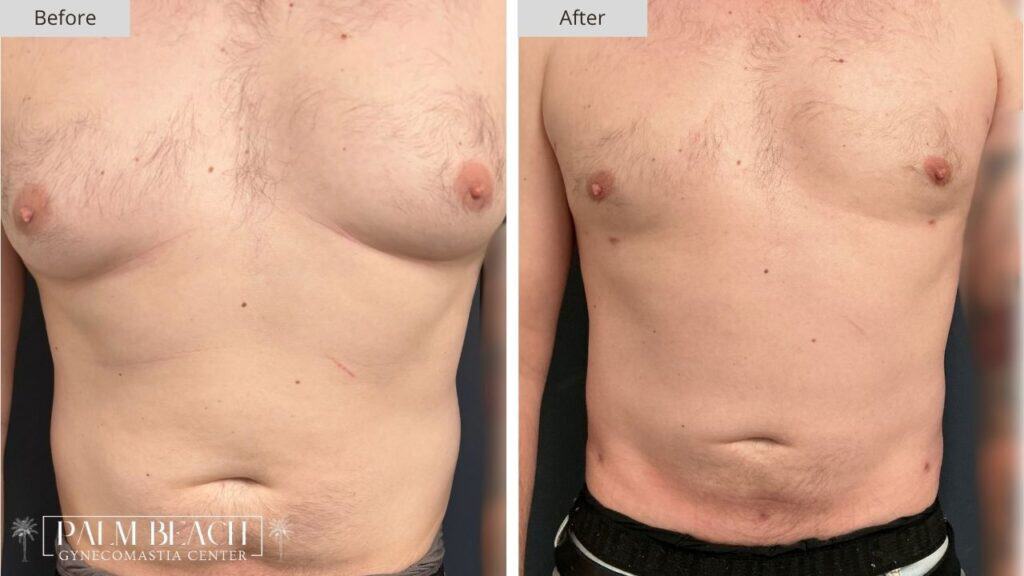 Palm Beach Gynecomastia Before and After 7a