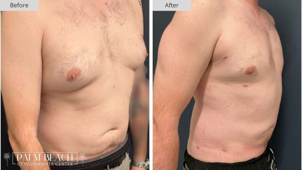 Palm Beach Gynecomastia Before and After 7b